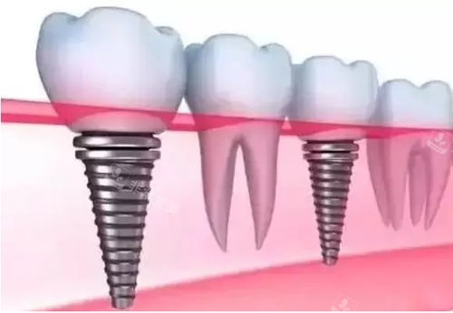 种植牙动画图示