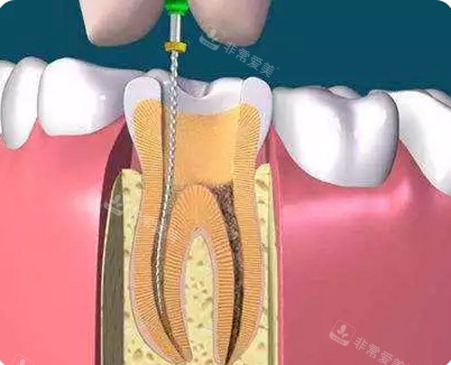 根管治疗图示