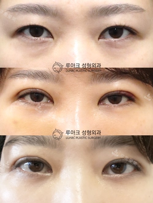 韩国luarc整形眼部提肌手术图