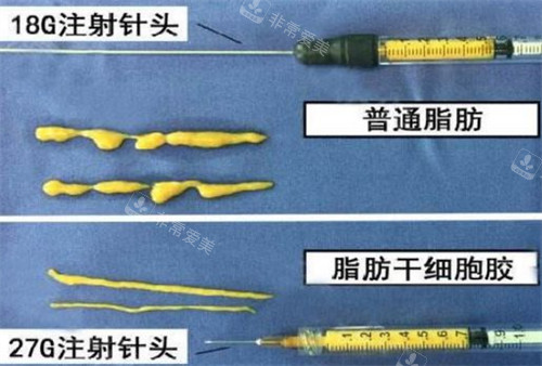 脂肪胶填充技术与普通自体脂肪填充的区别图解