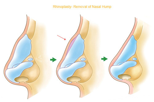 鼻整形过程图示