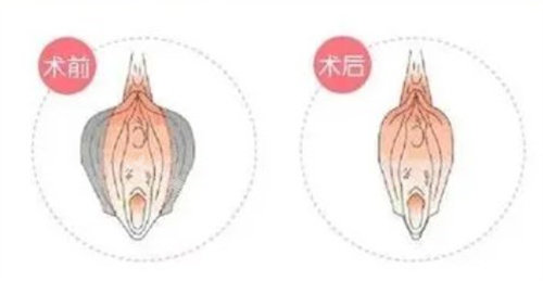 阴道紧缩术