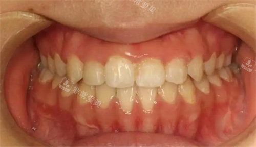 牙齿畸形照片