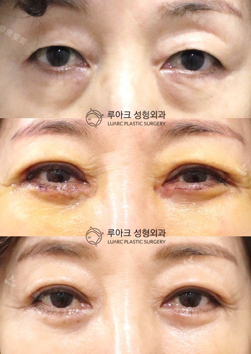 韩国luarc整形外科双眼皮前后图