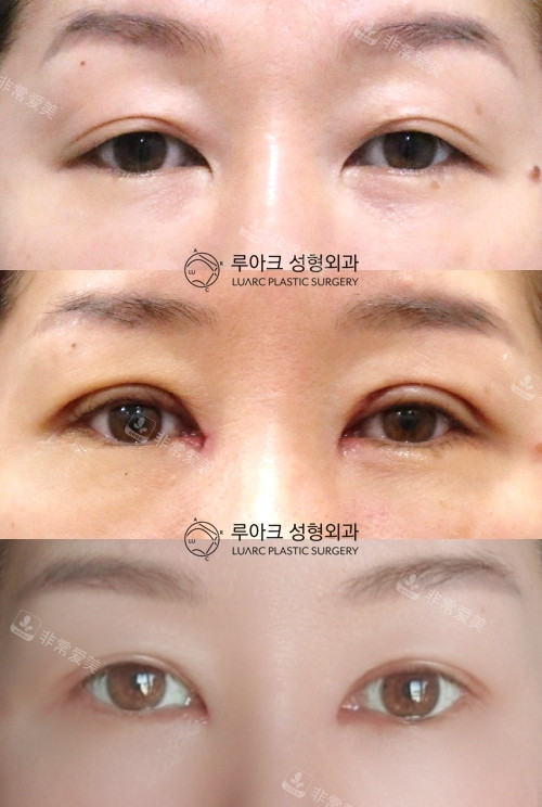 韩国luarc整形外科双眼皮宽降窄手术对比