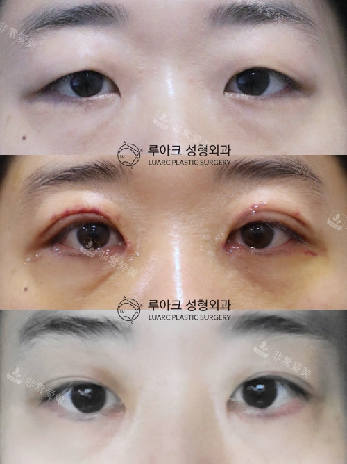 韩国luarc整形外科双眼皮手术对比照