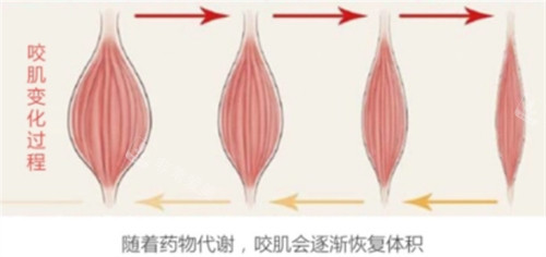 注射瘦脸类针剂后咬肌前后变化