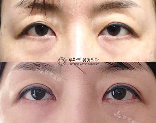 韩国luarc整形外科眼部整形对比图