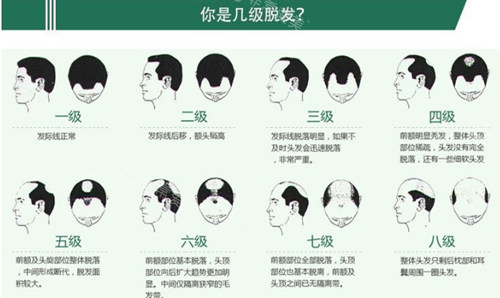 脫發(fā)等級圖示 脫發(fā)等級圖示
