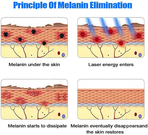 激光祛斑原理图示