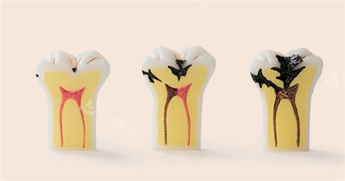 牙齿龋坏发展细节图