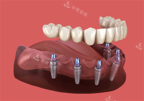 全口种植牙的样子图解