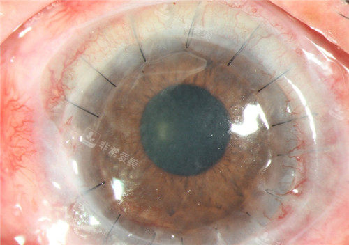 角膜手术细节图