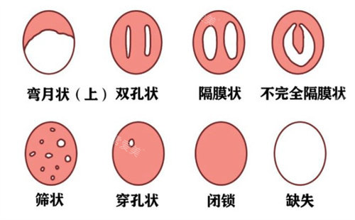 处女膜破裂