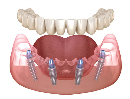 半口种植牙图示