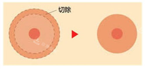 乳晕缩小手术