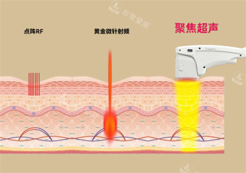 尖峰之星超声王仪器对比其他仪器的作用对比图