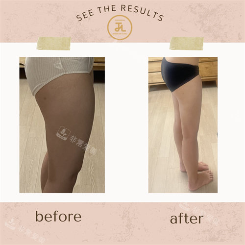 韓國清潭JASMINE LINE CLINIC腿部溶脂