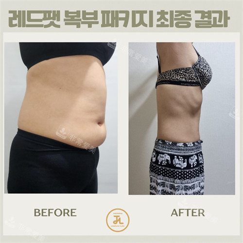 韩国清潭jasmine line身体体型管理前后对比图