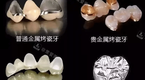 不同材质的牙冠照片