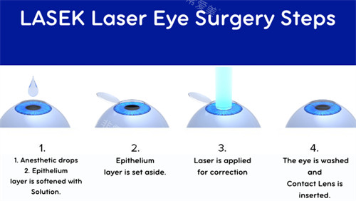 近视眼手术过程
