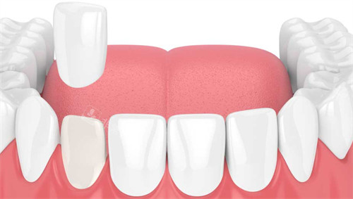 牙齿贴面改善牙齿缺损和颜色