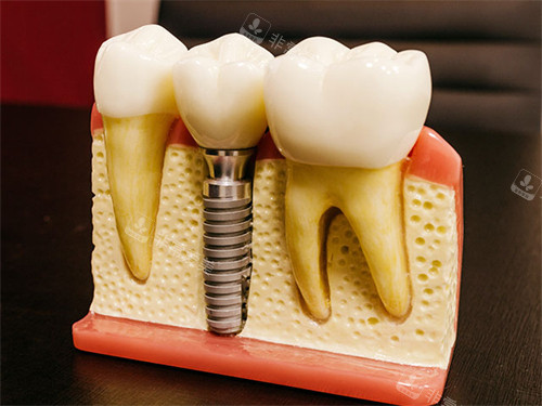种植牙模型图示