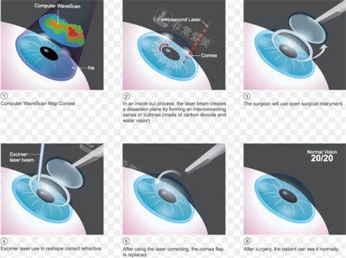 全飞秒手术过程图