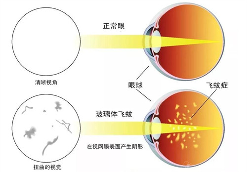 飞蚊症和正常眼睛对比