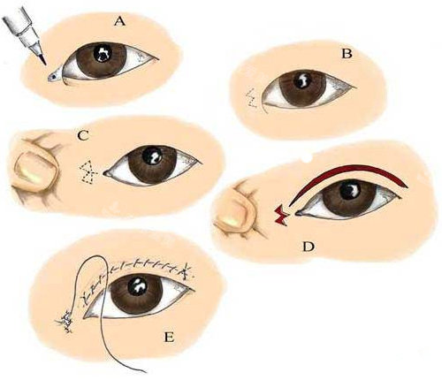 双眼皮手术过程图解