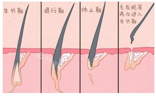 毛囊植发过程