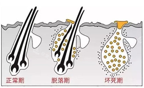 毛囊种植生长期