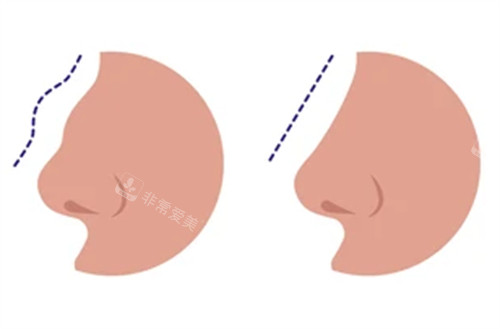 驼峰鼻矫正前后对比