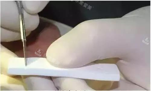 隆鼻使用的膨體假體