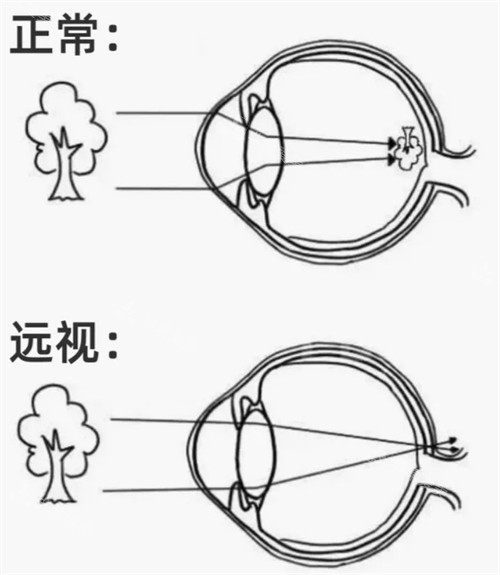 远视眼睛和正常眼镜成像区别