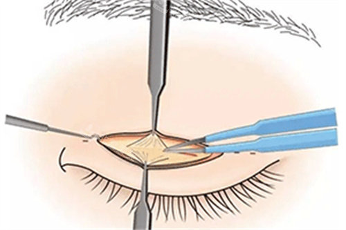 沧州星悦整形双眼皮手术过程图解