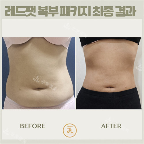 韓國(guó)清潭jasmineline clinic腰腹 韓國(guó)清潭jasmineline clinic腰腹