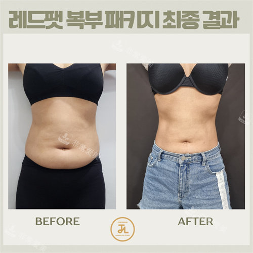 韓國清潭jasmine line clinic腰腹脂肪分解 韓國清潭jasmine line clinic腰腹脂肪分解