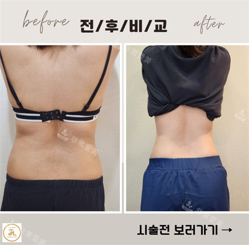 韓國清潭jasmine line clinic對比圖 韓國清潭jasmine line clinic對比圖