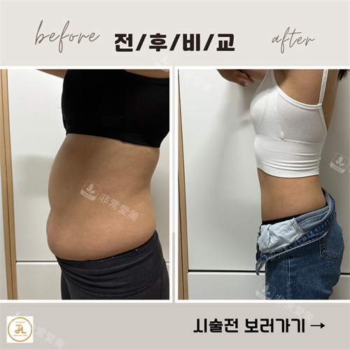韩国清潭jasmine line clinic腰腹塑形手术前后对比