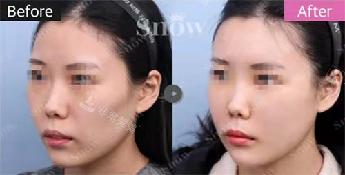 韓國snow整形自體脂肪填充側(cè)面對比圖 韓國snow整形自體脂肪填充側(cè)面對比圖