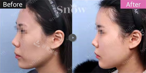韓國snow整形自體脂肪填充側(cè)面對比圖 韓國snow整形自體脂肪填充側(cè)面對比圖