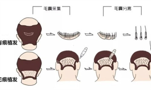 植发fue和fut差别