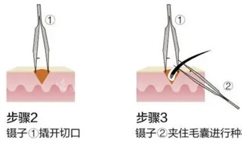 取毛囊的方法