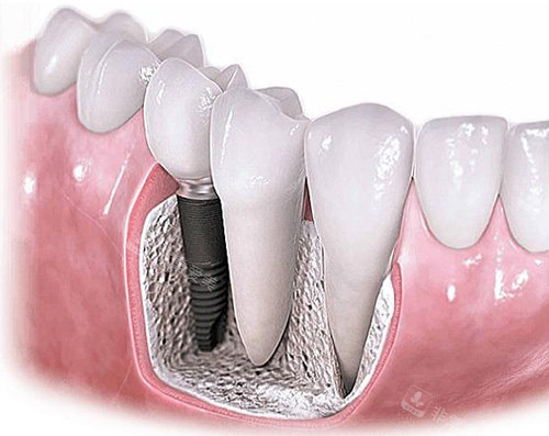 种植牙动画图示
