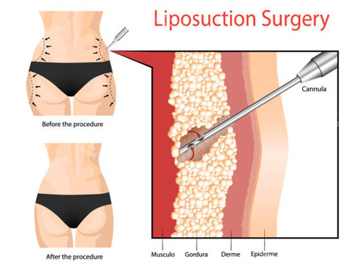 吸脂手术怎么做的