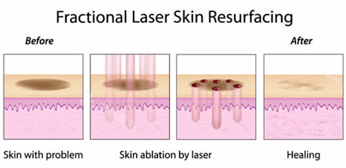 激光改善皮肤印子