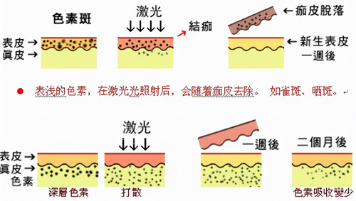 激光改善皮肤斑点