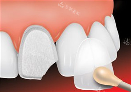 牙齿贴面改善缺损的牙齿