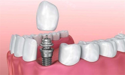 种植牙植入动画图